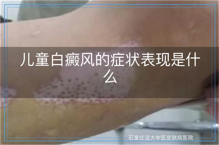 儿童白癜风的症状表现是什么