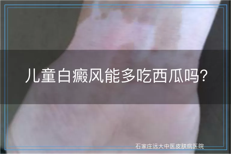 儿童白癜风能多吃西瓜吗？