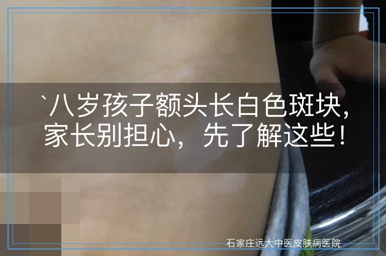 八岁孩子额头长白色斑块，家长别担心，先了解这些！