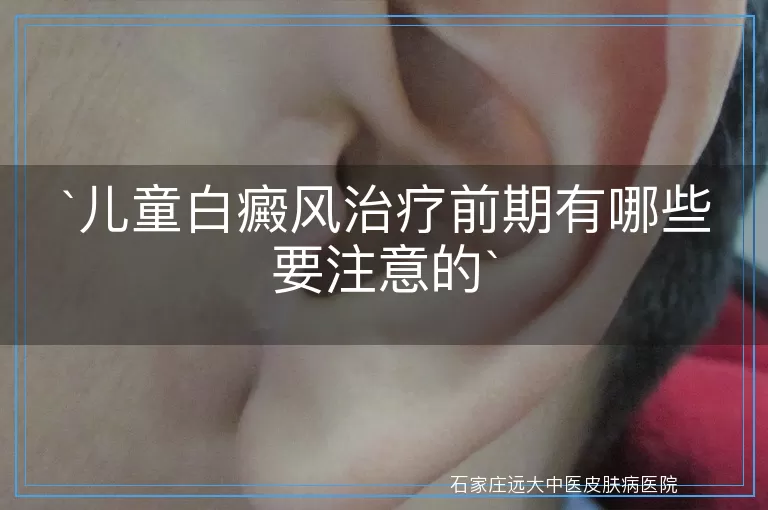 儿童白癜风治疗前期有哪些要注意的