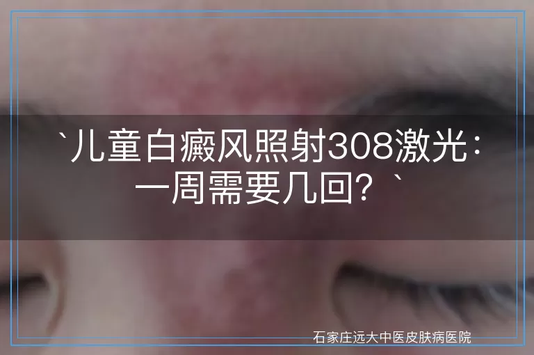 儿童白癜风照射308激光：一周需要几回？