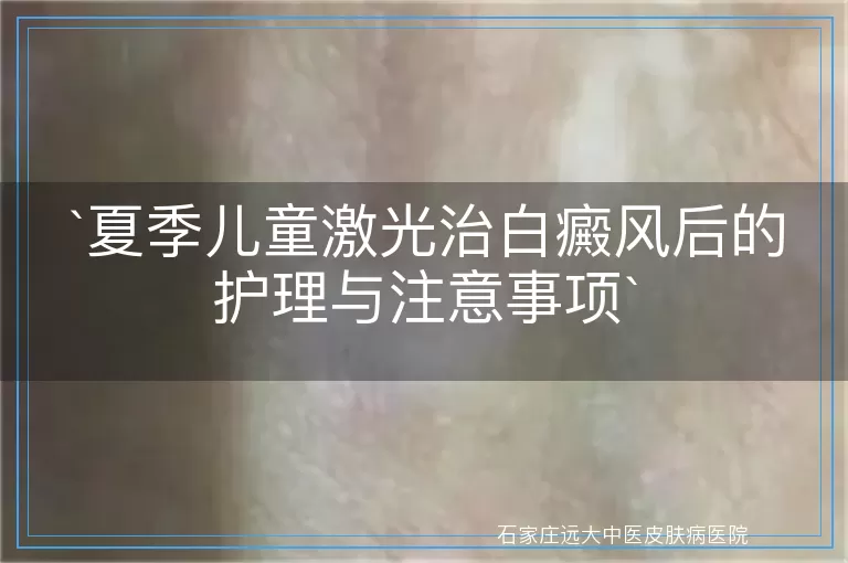 夏季儿童激光治白癜风后的护理与注意事项
