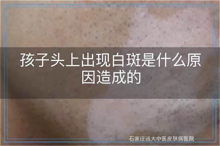 孩子头上出现白斑是什么原因造成的