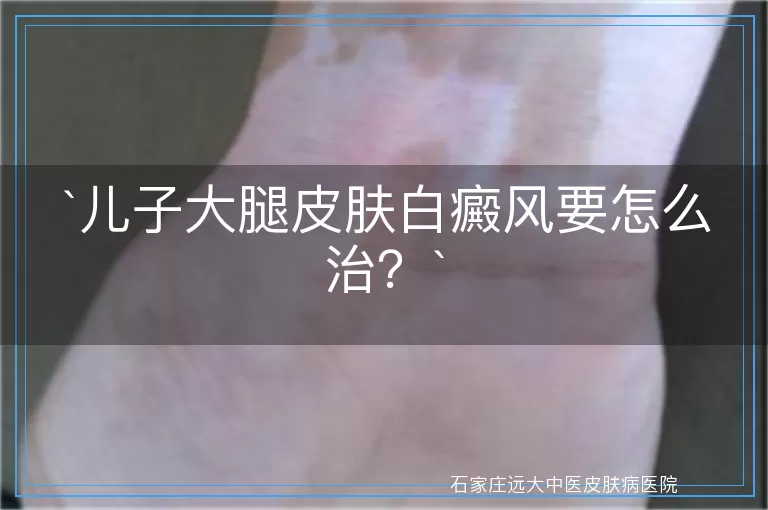 儿子大腿皮肤白癜风要怎么治？