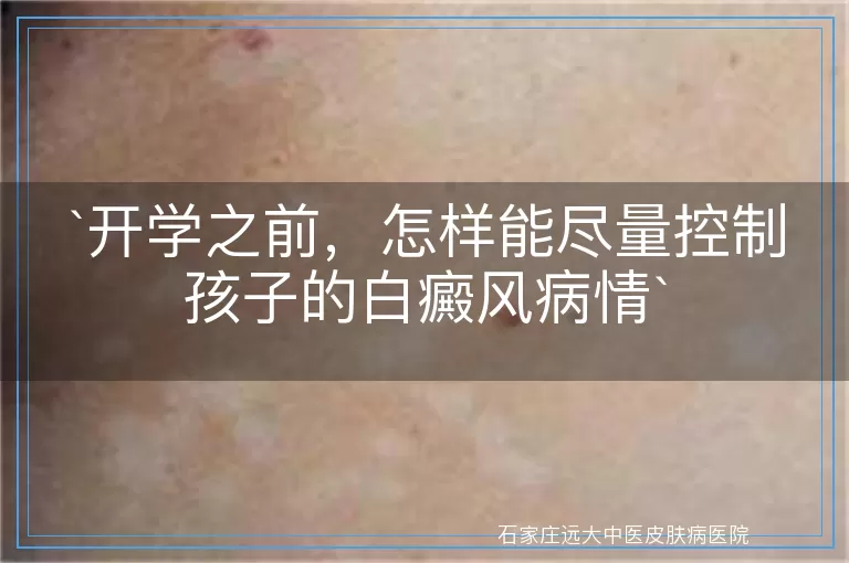 开学之前，怎样能尽量控制孩子的白癜风病情