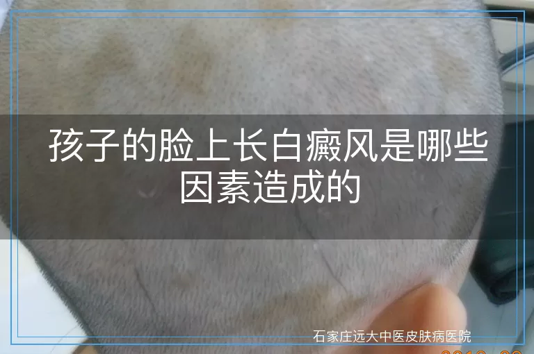 孩子的脸上长白癜风是哪些因素造成的