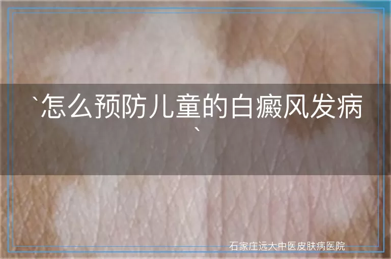 怎么预防儿童的白癜风发病