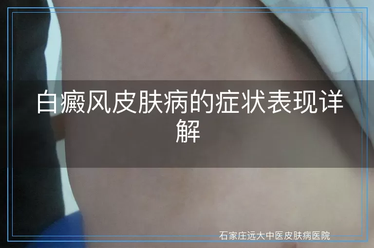 白癜风皮肤病的症状表现详解