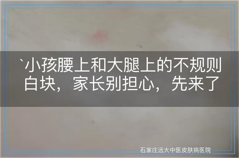 小孩腰上和大腿上的不规则白块，家长别担心，先来了解这些可能的原因