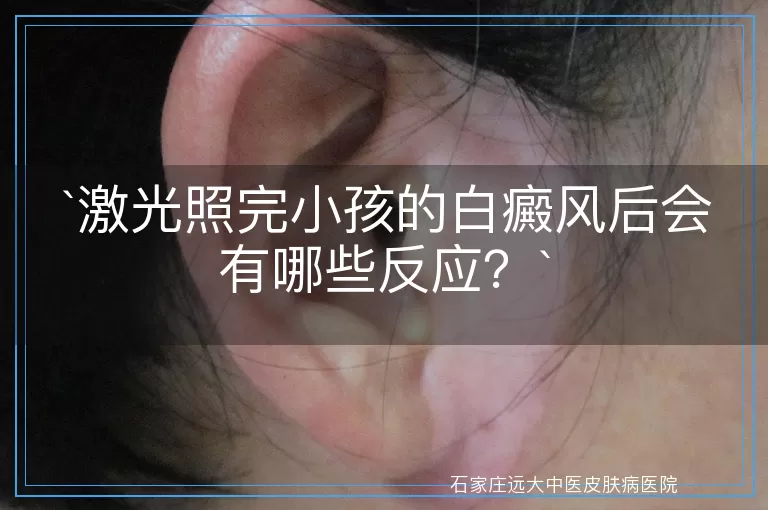 激光照完小孩的白癜风后会有哪些反应？