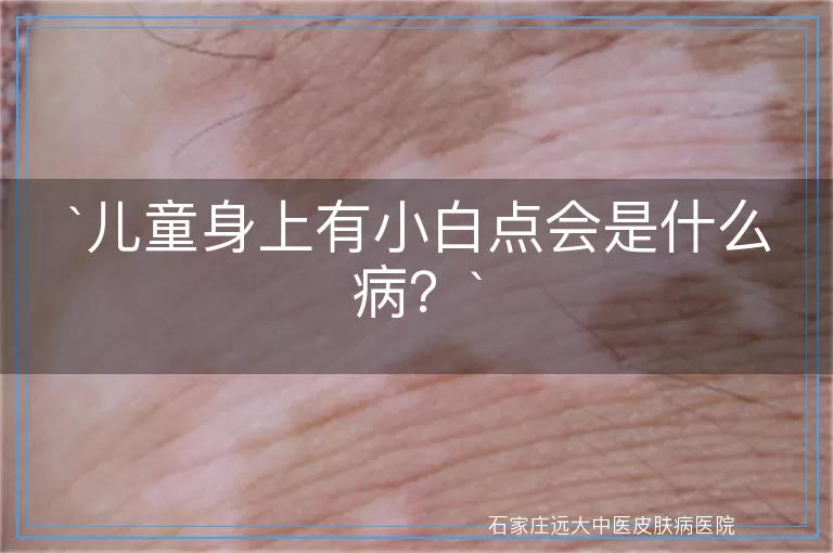 儿童身上有小白点会是什么病？