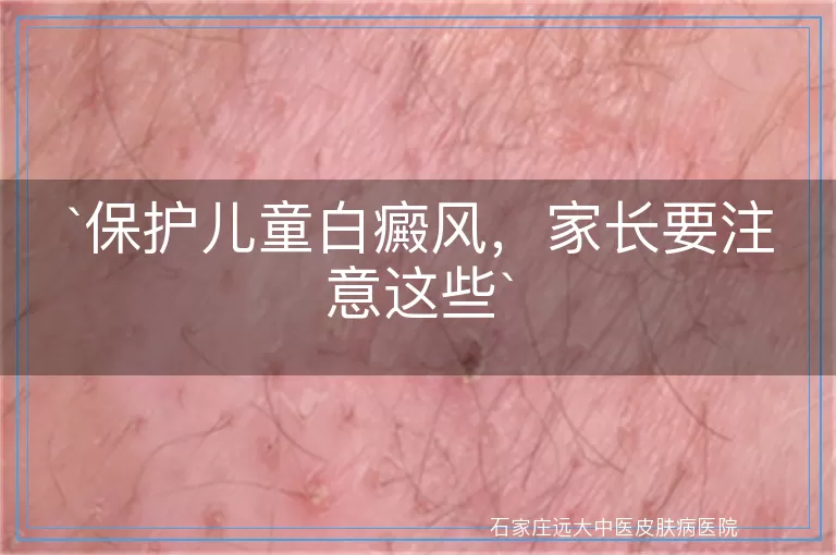 保护儿童白癜风，家长要注意这些