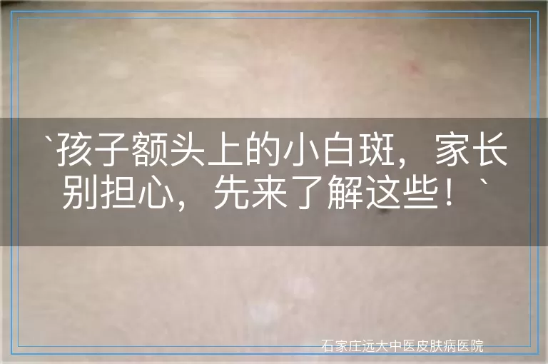 孩子额头上的小白斑，家长别担心，先来了解这些！