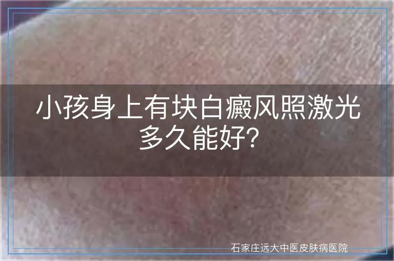小孩身上有块白癜风照激光多久能好？