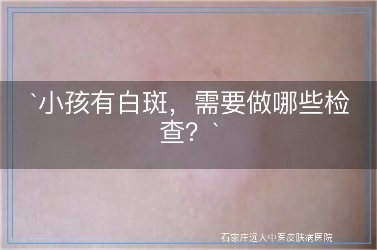 小孩有白斑，需要做哪些检查？