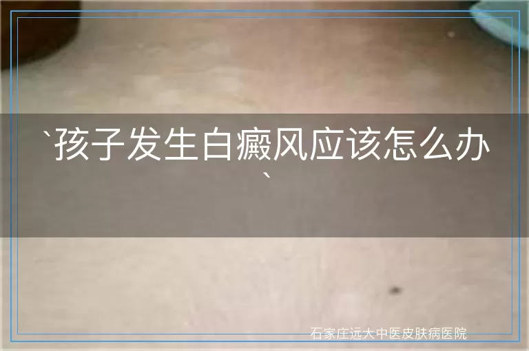 孩子发生白癜风应该怎么办
