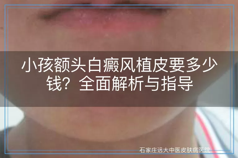 小孩额头白癜风植皮要多少钱?全面解析与指导