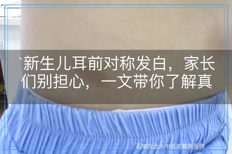 新生儿耳前对称发白，家长们别担心，一文带你了解真相