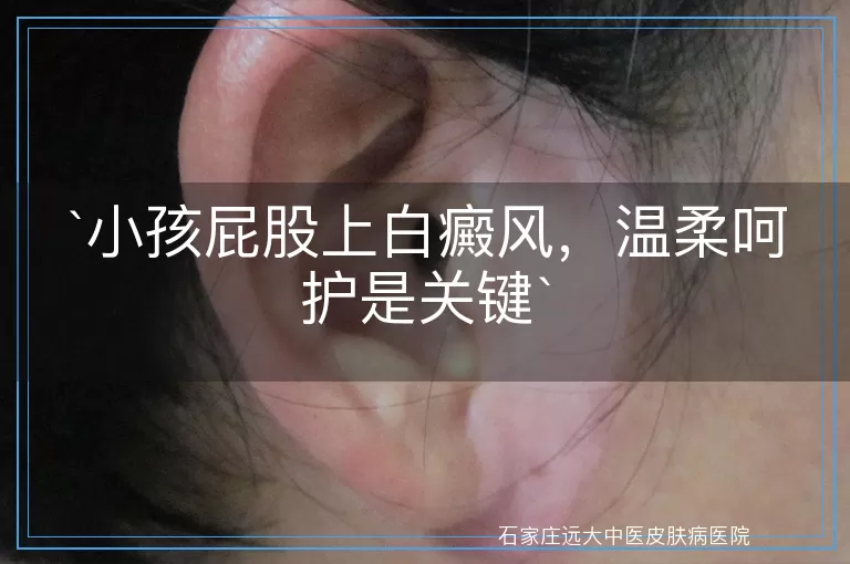 小孩屁股上白癜风，温柔呵护是关键