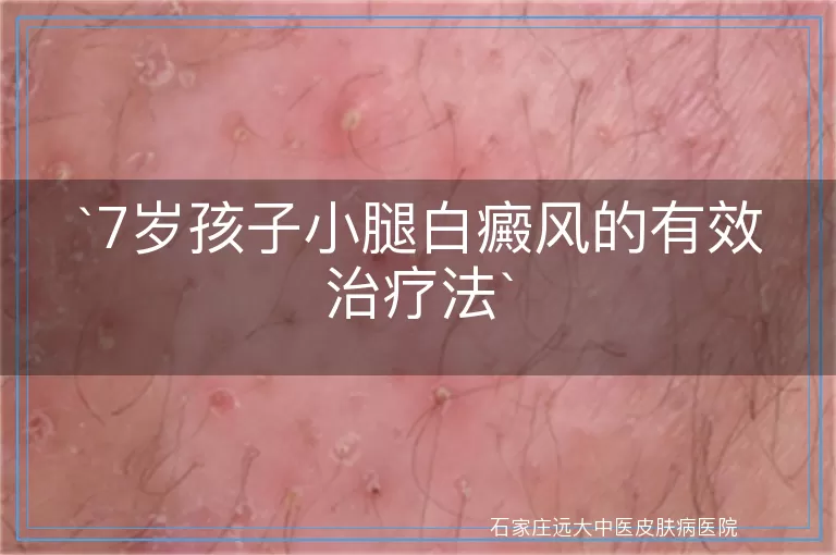 7岁孩子小腿白癜风的有效治疗法