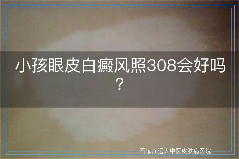 小孩眼皮白癜风照308会好吗？