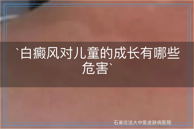 白癜风对儿童的成长有哪些危害