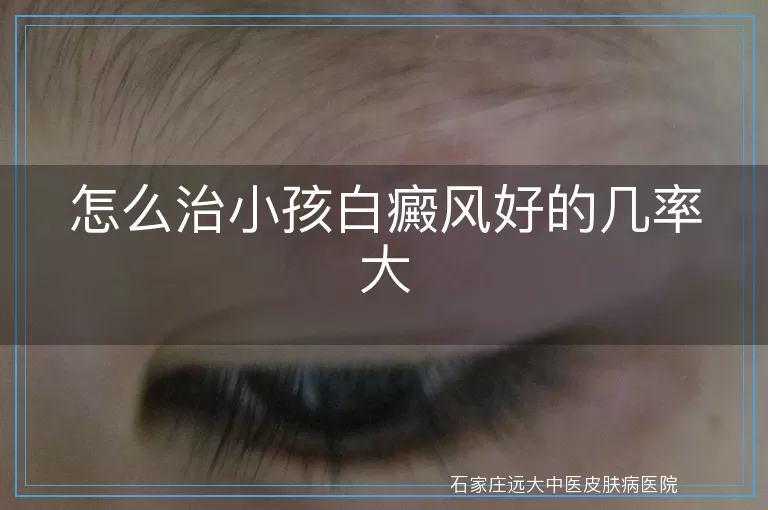 怎么治小孩白癜风好的几率大
