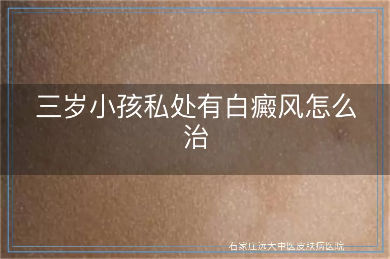 三岁小孩私处有白癜风怎么治