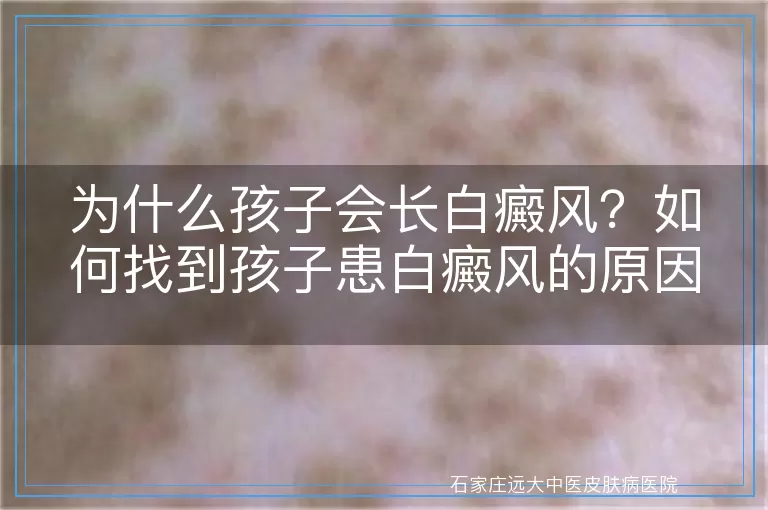 为什么孩子会长白癜风？如何找到孩子患白癜风的原因？