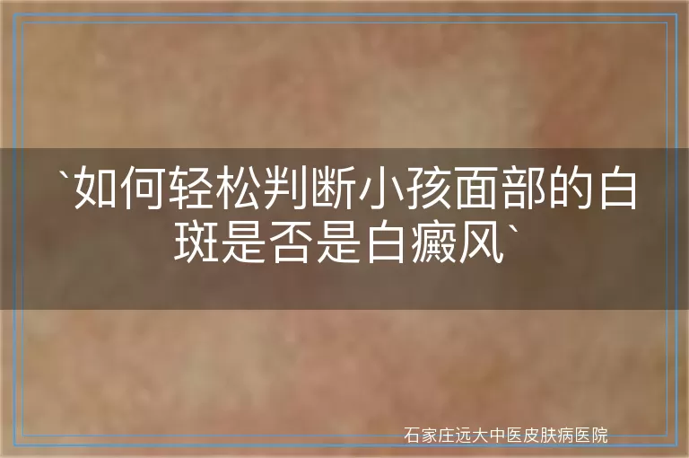 如何轻松判断小孩面部的白斑是否是白癜风