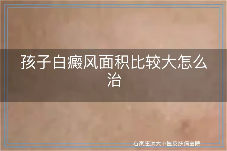 孩子白癜风面积比较大怎么治