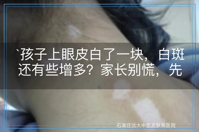孩子上眼皮白了一块，白斑还有些增多？家长别慌，先了解这些！