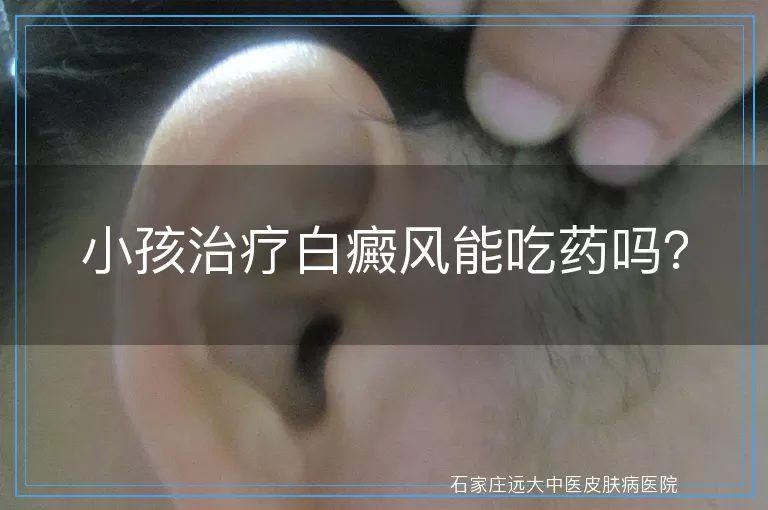 小孩治疗白癜风能吃药吗？