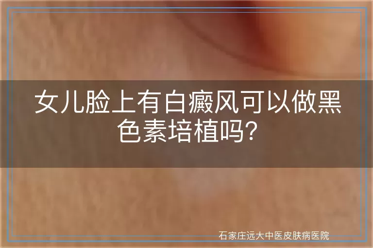 女儿脸上有白癜风可以做黑色素培植吗？