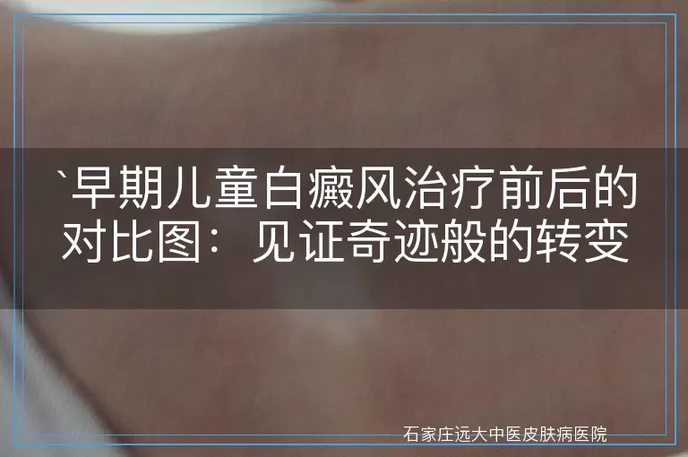 早期儿童白癜风治疗前后的对比图：见证奇迹般的转变