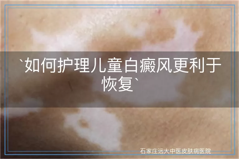 如何护理儿童白癜风更利于恢复