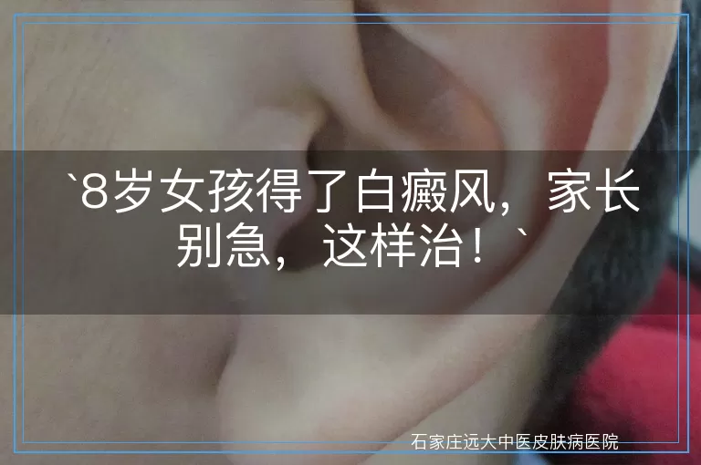 8岁女孩得了白癜风，家长别急，这样治！