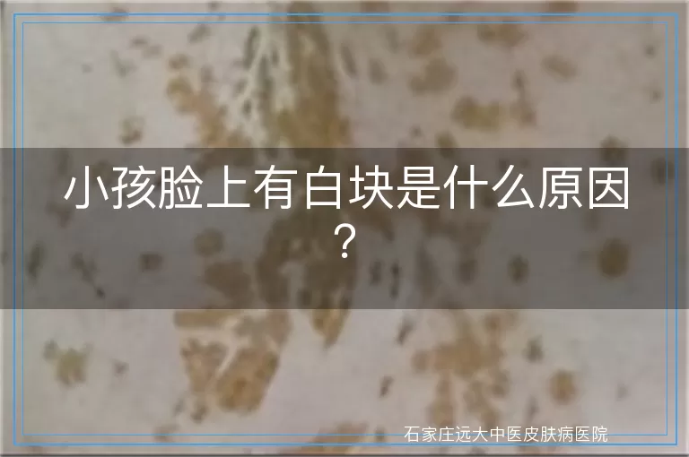 小孩脸上有白块是什么原因？