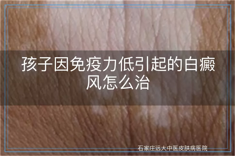孩子因免疫力低引起的白癜风怎么治
