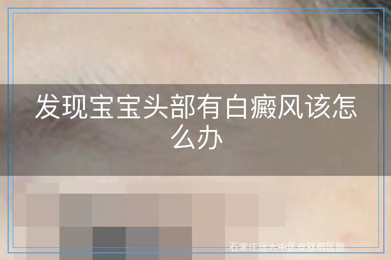 发现宝宝头部有白癜风该怎么办