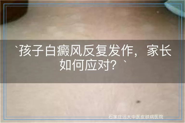 孩子白癜风反复发作，家长如何应对？