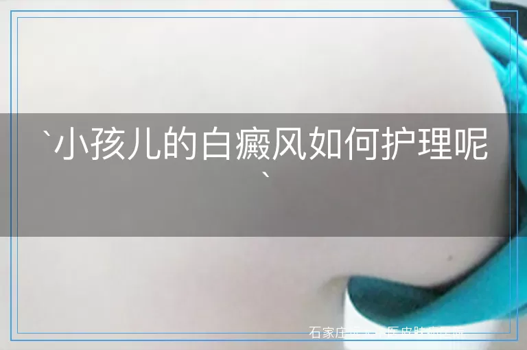 小孩儿的白癜风如何护理呢
