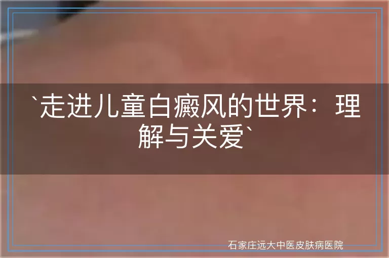 走进儿童白癜风的世界：理解与关爱