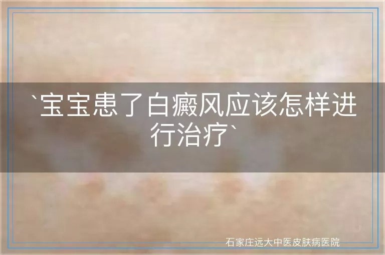 宝宝患了白癜风应该怎样进行治疗