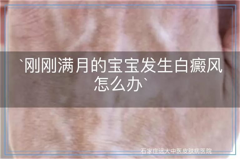 刚刚满月的宝宝发生白癜风怎么办