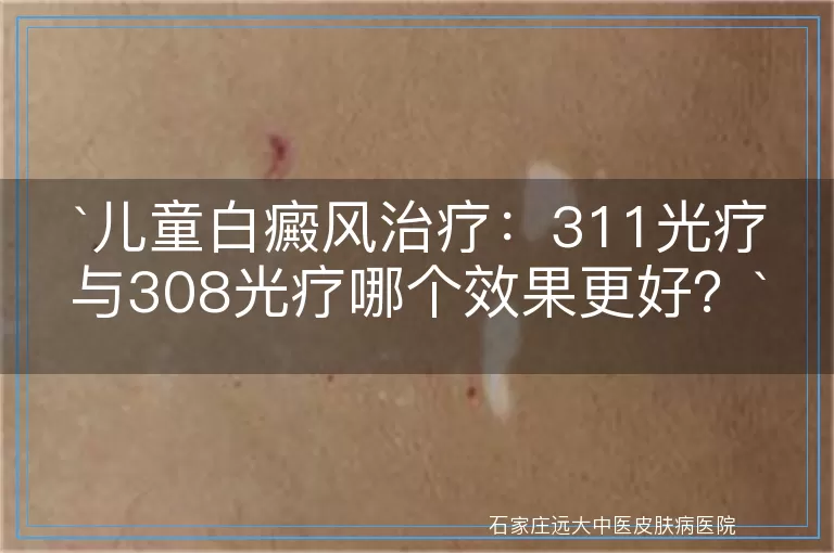 儿童白癜风治疗：311光疗与308光疗哪个效果更好？