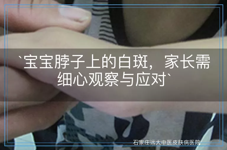 宝宝脖子上的白斑，家长需细心观察与应对