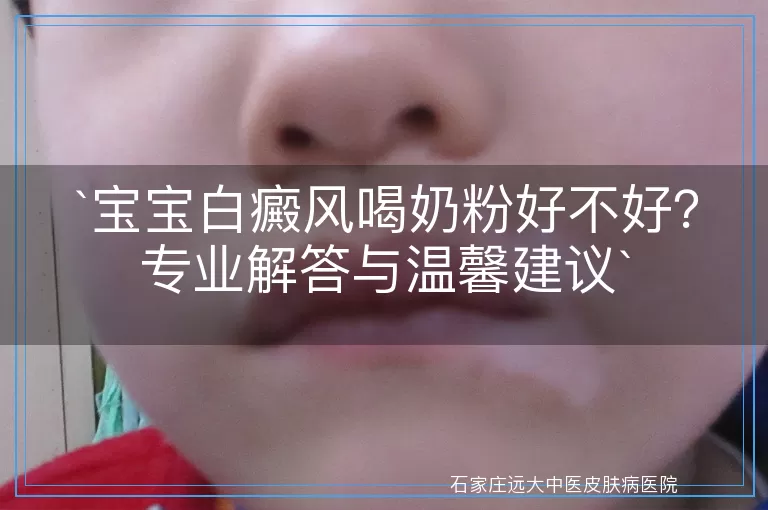 宝宝白癜风喝奶粉好不好？专业解答与温馨建议