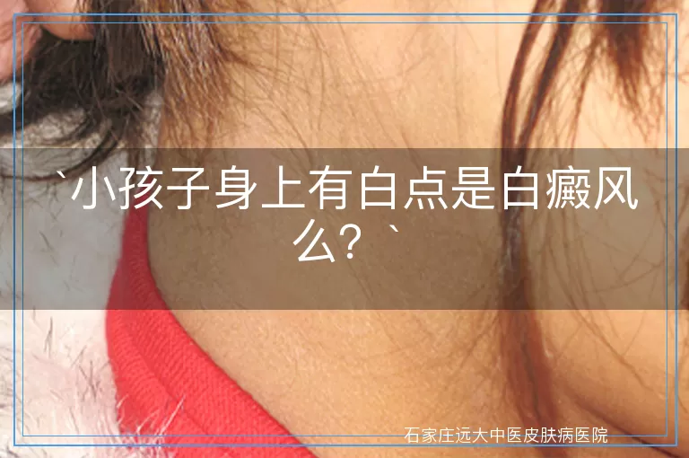 小孩子身上有白点是白癜风么？