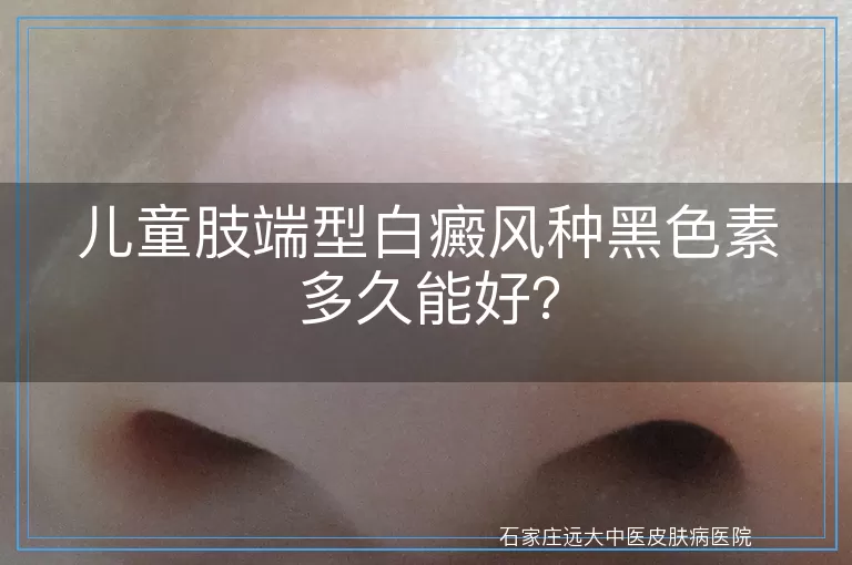儿童肢端型白癜风种黑色素多久能好？